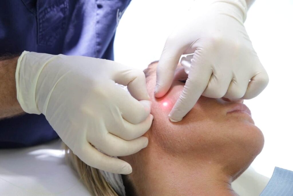 lifting facial cu laser chisinau