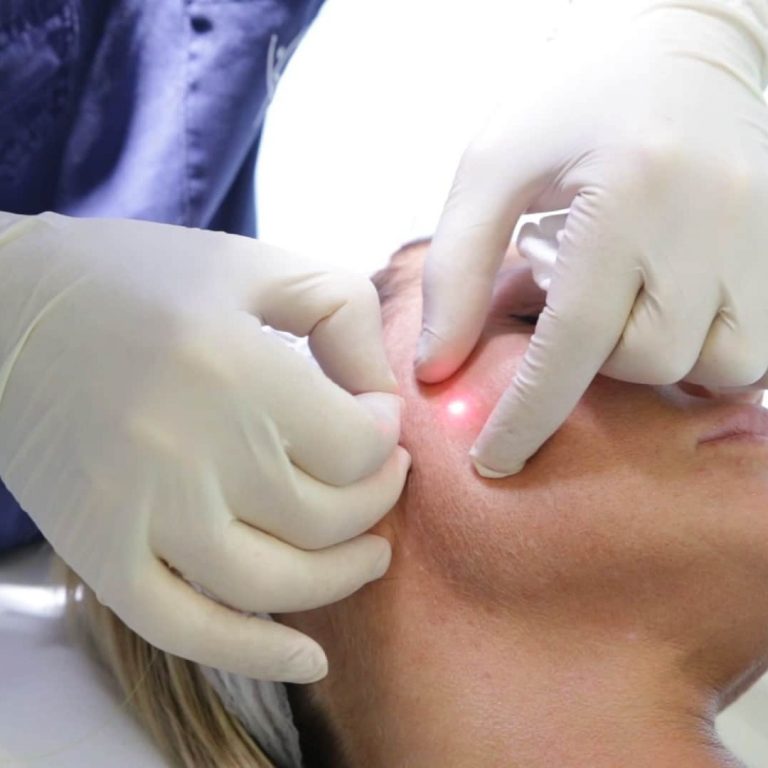 лазерная подтяжка лица кишинев